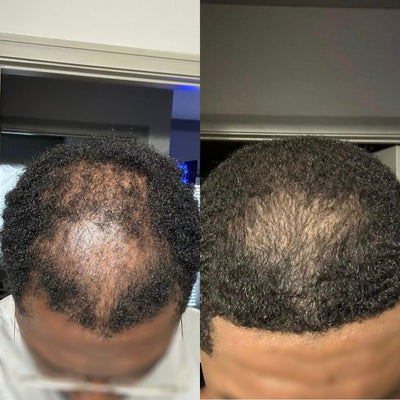 Rysmide Hair Growth Bar